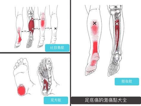 打腳板|足底筋膜炎的發生原因與如何治療？震波治療效果快！。